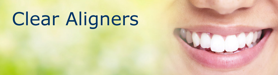 Clear Aligners